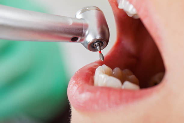 Best Emergency Dentist for Knocked-Out Tooth in Albion, IL